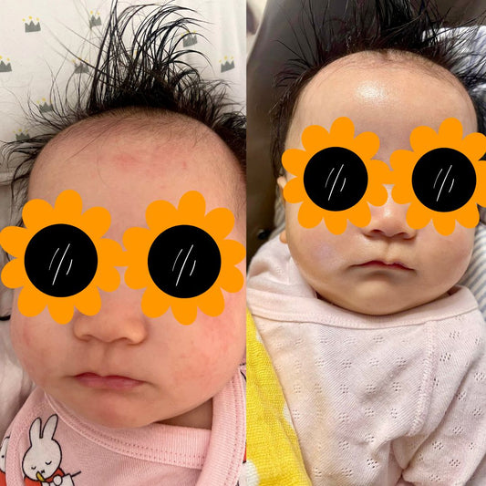 2024年3月(嬰幼兒濕疹)