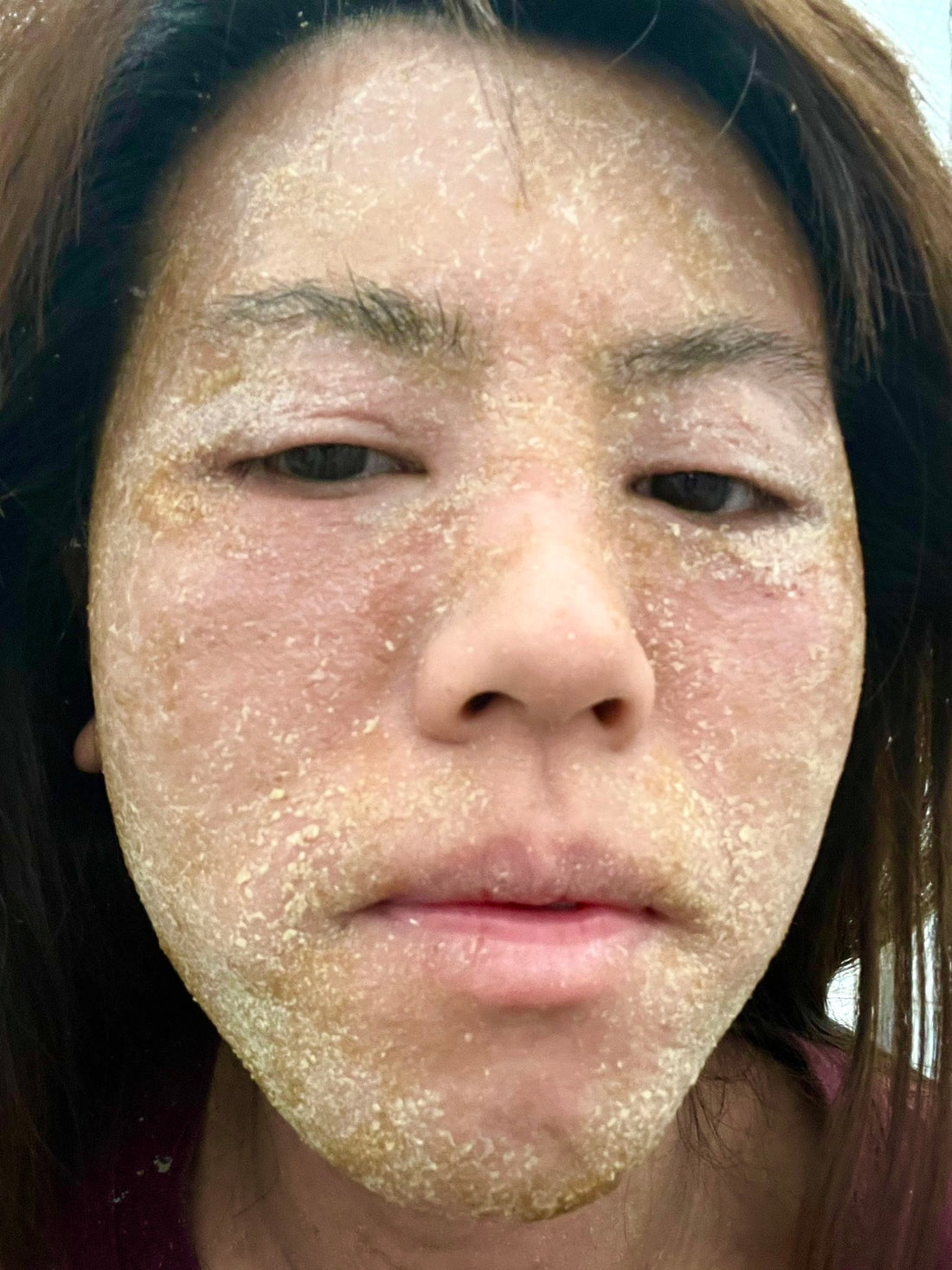 2024年4月(急性濕疹)客人批准出樣。