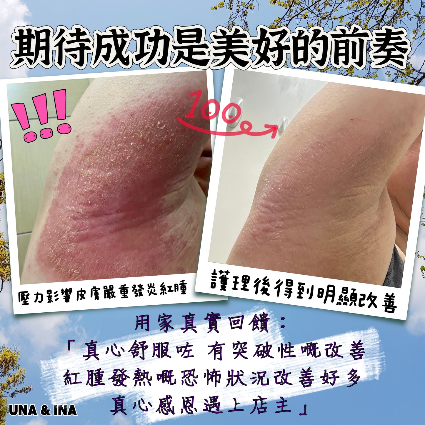 印度苦楝速效止痕乳液(嬰幼兒適用)- Step1