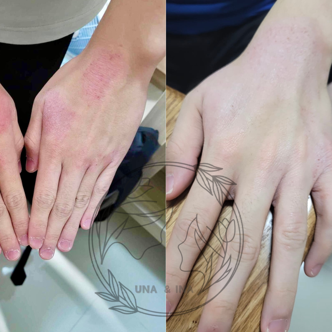 2024年6月(小女孩,手部長期乾燥)