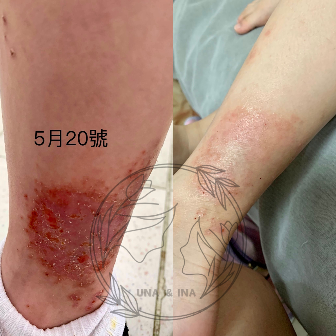 2024年6月(蚊蟲叮咬後嚴重敏感)