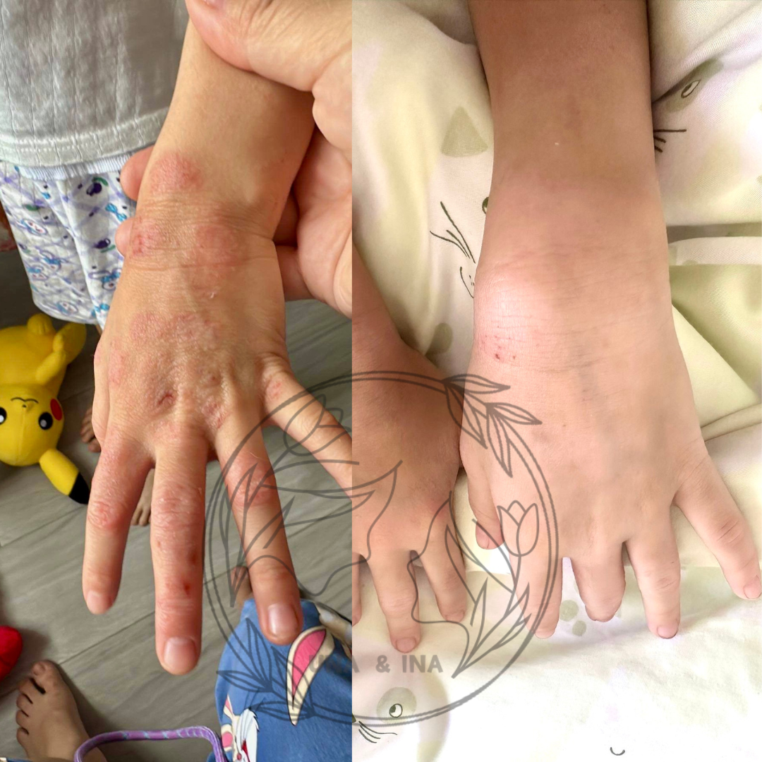 2024年6月(小女孩,濕疹)