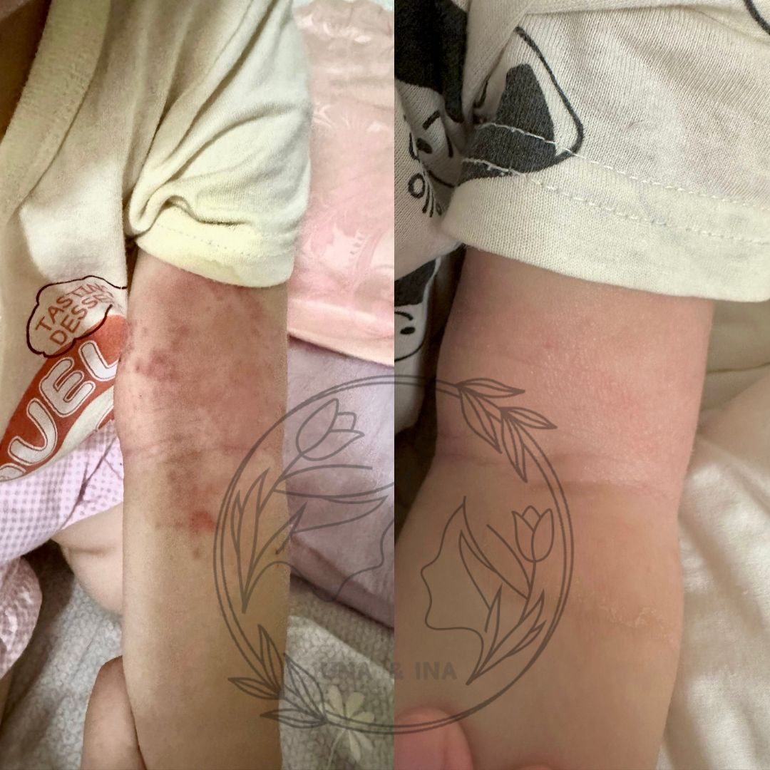 2024年5月(幼兒濕疹)